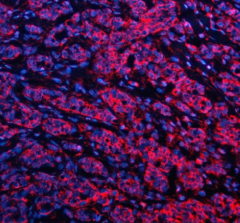 Immunofluorescent staining of GSTK1 using anti-GSTK1 antibody (red). GSTK1 was detected in a paraffin-embedded section of human breast cancer tissue. Heat mediated antigen retrieval was performed in EDTA buffer (pH 8.0, epitope retrieval solution). The tissue section was blocked with 10% goat serum. The tissue section was then incubated with 5 ug/ml rabbit anti-GSTK1 antibody overnight at 4oC. Cy3 Conjugated Goat Anti-Rabbit IgG was used as secondary antibody at 1:500 dilution and incubated for 30 minutes at 37oC. The section was counterstained with DAPI nuclear stain (blue). Visualize using a fluorescence microscope and filter sets appropriate for the label used.