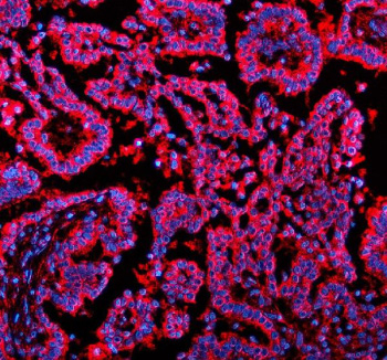 Immunofluorescent staining of NSDHL using anti-NSDHL antibody (red). NSDHL was detected in a paraffin-embedded section of human lung cancer tissue. Heat mediated antigen retrieval was performed in EDTA buffer (pH 8.0, epitope retrieval solution). The tissue section was blocked with 10% goat serum. The tissue section was then incubated with 5 ug/ml rabbit anti-NSDHL antibody overnight at 4oC. Cy3 Conjugated Goat Anti-Rabbit IgG was used as secondary antibody at 1:500 dilution and incubated for 30 minutes at 37oC. The section was counterstained with DAPI nuclear stain (blue). Visualize using a fluorescence microscope and filter sets appropriate for the label used.
