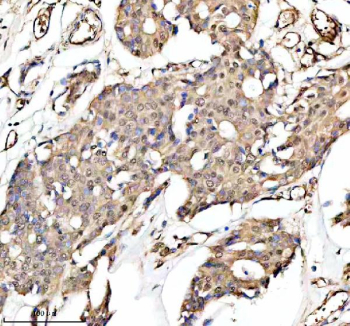 Immunohistochemical staining of PUF60 using anti-PUF60 antibody. PUF60 was detected in a paraffin-embedded section of human breast cancer tissue. Heat mediated antigen retrieval was performed in EDTA buffer (pH 8.0, epitope retrieval solution). The tissue section was blocked with 10% goat serum. The tissue section was then incubated with 2 ug/ml rabbit anti-PUF60 antibody overnight at 4oC. Peroxidase Conjugated Goat Anti-rabbit IgG was used as secondary antibody and incubated for 30 minutes at 37oC. The tissue section was developed using an HRP secondary and DAB substrate.