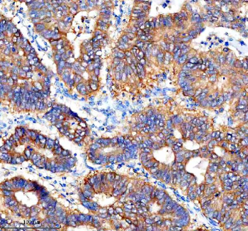 Immunohistochemical staining of Cathepsin F/CTSF using anti-CTSF antibody. Cathepsin F/CTSF was detected in a paraffin-embedded section of human stomach cancer tissue. Heat mediated antigen retrieval was performed in EDTA buffer (pH 8.0, epitope retrieval solution). The tissue section was blocked with 10% goat serum. The tissue section was then incubated with 2 ug/ml rabbit anti-CTSF antibody overnight at 4oC. Peroxidase Conjugated Goat Anti-rabbit IgG was used as secondary antibody and incubated for 30 minutes at 37oC. The tissue section was developed using an HRP secondary and DAB substrate.