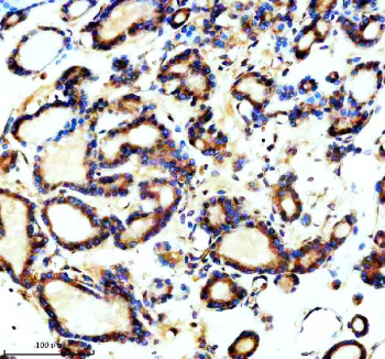 Immunohistochemical staining of TCTN1 using anti-TCTN1 antibody. TCTN1 was detected in a paraffin-embedded section of human thyroid cancer tissue. Heat mediated antigen retrieval was performed in EDTA buffer (pH 8.0, epitope retrieval solution). The tissue section was blocked with 10% goat serum. The tissue section was then incubated with 2 ug/ml rabbit anti-TCTN1 antibody overnight at 4oC. Peroxidase Conjugated Goat Anti-rabbit IgG was used as secondary antibody and incubated for 30 minutes at 37oC. The tissue section was developed using an HRP secondary and DAB substrate.