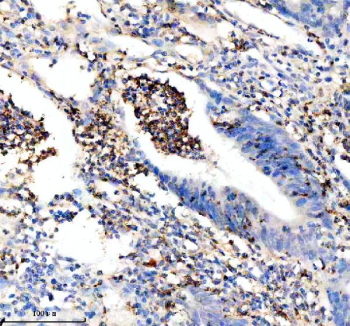 Immunohistochemical staining of Granzyme M/GZMM using anti-GZMM antibody. Granzyme M/GZMM was detected in a paraffin-embedded section of human colon cancer tissue. Heat mediated antigen retrieval was performed in EDTA buffer (pH 8.0, epitope retrieval solution). The tissue section was blocked with 10% goat serum. The tissue section was then incubated with 2 ug/ml rabbit anti-GZMM antibody overnight at 4oC. Peroxidase Conjugated Goat Anti-rabbit IgG was used as secondary antibody and incubated for 30 minutes at 37oC. The tissue section was developed using an HRP secondary and DAB substrate.