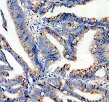 Immunohistochemical staining of SPINK4 using anti-SPINK4 antibody. SPINK4 was detected in a paraffin-embedded section of human colon cancer tissue. Heat mediated antigen retrieval was performed in EDTA buffer (pH 8.0, epitope retrieval solution). The tissue section was blocked with 10% goat serum. The tissue section was then incubated with 2 ug/ml rabbit anti-SPINK4 antibody overnight at 4oC. Peroxidase Conjugated Goat Anti-rabbit IgG was used as secondary antibody and incubated for 30 minutes at 37oC. The tissue section was developed using an HRP secondary and DAB substrate.