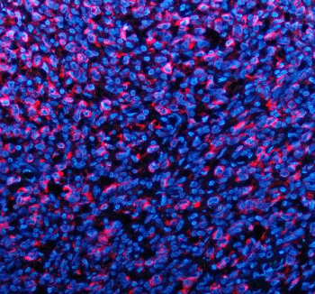 Immunofluorescent staining of TYRP1 using anti-TYRP1 antibody (red). TYRP1 was detected in a paraffin-embedded section of human melanoma tissue. Heat mediated antigen retrieval was performed in EDTA buffer (pH 8.0, epitope retrieval solution). The tissue section was blocked with 10% goat serum. The tissue section was then incubated with 5 ug/ml rabbit anti-TYRP1 antibody overnight at 4oC. Cy3 Conjugated Goat Anti-Rabbit IgG was used as secondary antibody at 1:500 dilution and incubated for 30 minutes at 37oC. The section was counterstained with DAPI nuclear stain (blue). Visualize using a fluorescence microscope and filter sets appropriate for the label used.