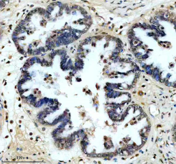Immunohistochemical staining of SRA1 using anti-SRA1 antibody. SRA1 was detected in a paraffin-embedded section of human ovarian cancer tissue. Heat mediated antigen retrieval was performed in EDTA buffer (pH 8.0, epitope retrieval solution). The tissue section was blocked with 10% goat serum. The tissue section was then incubated with 1: 200 rabbit anti-SRA1 antibody overnight at 4oC. Peroxidase Conjugated Goat Anti-rabbit IgG was used as secondary antibody and incubated for 30 minutes at 37oC. The tissue section was developed using an HRP secondary and DAB substrate.