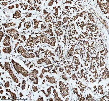 Immunohistochemical staining of DIS3 using anti-DIS3 antibody. DIS3 was detected in a paraffin-embedded section of human breast cancer tissue. Heat mediated antigen retrieval was performed in EDTA buffer (pH 8.0, epitope retrieval solution). The tissue section was blocked with 10% goat serum. The tissue section was then incubated with 2 ug/ml rabbit anti-DIS3 antibody overnight at 4oC. Peroxidase Conjugated Goat Anti-rabbit IgG was used as secondary antibody and incubated for 30 minutes at 37oC. The tissue section was developed using an HRP secondary and DAB substrate.
