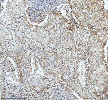 Immunohistochemical staining of SBK1 using anti-SBK1 antibody. SBK1 was detected in a paraffin-embedded section of human lung cancer tissue. Heat mediated antigen retrieval was performed in EDTA buffer (pH 8.0, epitope retrieval solution). The tissue section was blocked with 10% goat serum. The tissue section was then incubated with 2 ug/ml rabbit anti-SBK1 antibody overnight at 4oC. Peroxidase Conjugated Goat Anti-rabbit IgG was used as secondary antibody and incubated for 30 minutes at 37oC. The tissue section was developed using an HRP secondary and DAB substrate.