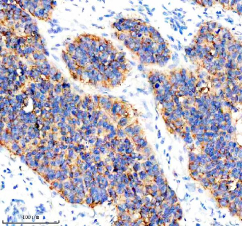 Immunohistochemical staining of CYP2W1 using anti-CYP2W1 antibody. CYP2W1 was detected in a paraffin-embedded section of human breast cancer tissue. Heat mediated antigen retrieval was performed in EDTA buffer (pH 8.0, epitope retrieval solution). The tissue section was blocked with 10% goat serum. The tissue section was then incubated with 2 ug/ml rabbit anti-CYP2W1 antibody overnight at 4oC. Peroxidase Conjugated Goat Anti-rabbit IgG was used as secondary antibody and incubated for 30 minutes at 37oC. The tissue section was developed using an HRP secondary and DAB substrate.