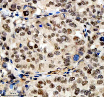 Immunohistochemical staining of SCAF11 using anti-SCAF11 antibody. SCAF11 was detected in a paraffin-embedded section of human cervical cancer tissue. Heat mediated antigen retrieval was performed in EDTA buffer (pH 8.0, epitope retrieval solution). The tissue section was blocked with 10% goat serum. The tissue section was then incubated with 2 ug/ml rabbit anti-SCAF11 antibody overnight at 4oC. Peroxidase Conjugated Goat Anti-rabbit IgG was used as secondary antibody and incubated for 30 minutes at 37oC. The tissue section was developed using an HRP secondary and DAB substrate.
