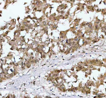 Immunohistochemical staining of NR1D2 using anti-NR1D2 antibody. NR1D2 was detected in a paraffin-embedded section of human liver cancer tissue. Heat mediated antigen retrieval was performed in EDTA buffer (pH 8.0, epitope retrieval solution). The tissue section was blocked with 10% goat serum. The tissue section was then incubated with 2 ug/ml rabbit anti-NR1D2 antibody overnight at 4oC. Peroxidase Conjugated Goat Anti-rabbit IgG was used as secondary antibody and incubated for 30 minutes at 37oC. The tissue section was developed using an HRP secondary and DAB substrate.