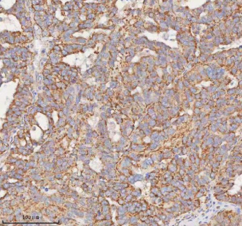 Immunohistochemical staining of SLC7A7 using anti-SLC7A7 antibody. SLC7A7 was detected in a paraffin-embedded section of human ovarian cancer tissue. Heat mediated antigen retrieval was performed in EDTA buffer (pH 8.0, epitope retrieval solution). The tissue section was blocked with 10% goat serum. The tissue section was then incubated with 2 ug/ml rabbit anti-SLC7A7 antibody overnight at 4oC. Peroxidase Conjugated Goat Anti-rabbit IgG was used as secondary antibody and incubated for 30 minutes at 37oC. The tissue section was developed using an HRP secondary and DAB substrate.
