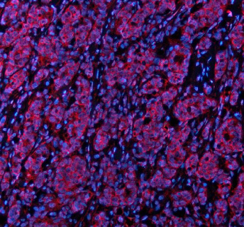 Immunofluorescent staining of STXBP3 using anti-STXBP3 antibody (red). STXBP3 was detected in a paraffin-embedded section of human breast cancer tissue. Heat mediated antigen retrieval was performed in EDTA buffer (pH 8.0, epitope retrieval solution). The tissue section was blocked with 10% goat serum. The tissue section was then incubated with 5 ug/ml rabbit anti-STXBP3 antibody overnight at 4oC. Cy3 Conjugated Goat Anti-Rabbit IgG was used as secondary antibody at 1:500 dilution and incubated for 30 minutes at 37oC. The section was counterstained with DAPI nuclear stain (blue). Visualize using a fluorescence microscope and filter sets appropriate for the label used.