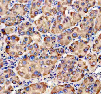 Immunohistochemical staining of TRIM40 using anti-TRIM40 antibody. TRIM40 was detected in a paraffin-embedded section of human liver cancer tissue. Heat mediated antigen retrieval was performed in EDTA buffer (pH 8.0, epitope retrieval solution). The tissue section was blocked with 10% goat serum. The tissue section was then incubated with 2 ug/ml rabbit anti-TRIM40 antibody overnight at 4oC. Peroxidase Conjugated Goat Anti-rabbit IgG was used as secondary antibody and incubated for 30 minutes at 37oC. The tissue section was developed using an HRP secondary and DAB substrate.