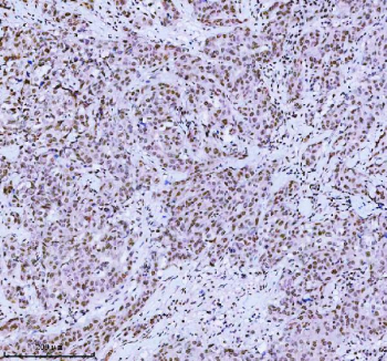 Immunohistochemical staining of MED4 using anti-MED4 antibody. MED4 was detected in a paraffin-embedded section of human breast cancer tissue. Heat mediated antigen retrieval was performed in EDTA buffer (pH 8.0, epitope retrieval solution). The tissue section was blocked with 10% goat serum. The tissue section was then incubated with 2 ug/ml rabbit anti-MED4 antibody overnight at 4oC. Peroxidase Conjugated Goat Anti-rabbit IgG was used as secondary antibody and incubated for 30 minutes at 37oC. The tissue section was developed using an HRP secondary and DAB substrate.