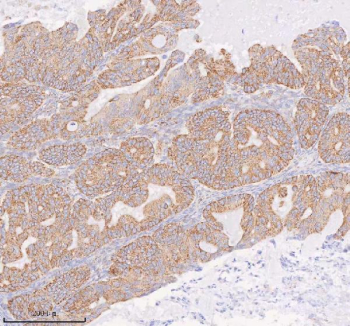 Immunohistochemical staining of COQ8B using anti-COQ8B antibody. COQ8B was detected in a paraffin-embedded section of human ovarian cancer tissue. Heat mediated antigen retrieval was performed in EDTA buffer (pH 8.0, epitope retrieval solution). The tissue section was blocked with 10% goat serum. The tissue section was then incubated with 2 ug/ml rabbit anti-COQ8B antibody overnight at 4oC. Peroxidase Conjugated Goat Anti-rabbit IgG was used as secondary antibody and incubated for 30 minutes at 37oC. The tissue section was developed using an HRP secondary and DAB substrate.