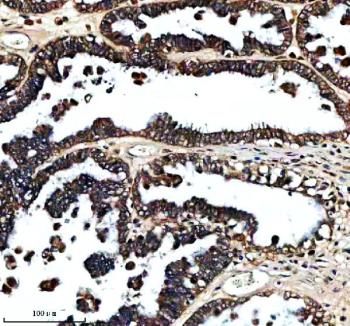 Immunohistochemical staining of FXN using anti-FXN antibody. FXN was detected in a paraffin-embedded section of human ovarian cancer tissue. Heat mediated antigen retrieval was performed in EDTA buffer (pH 8.0, epitope retrieval solution). The tissue section was blocked with 10% goat serum. The tissue section was then incubated with 2 ug/ml rabbit anti-FXN antibody overnight at 4oC. Peroxidase Conjugated Goat Anti-rabbit IgG was used as secondary antibody and incubated for 30 minutes at 37oC. The tissue section was developed using an HRP secondary and DAB substrate.