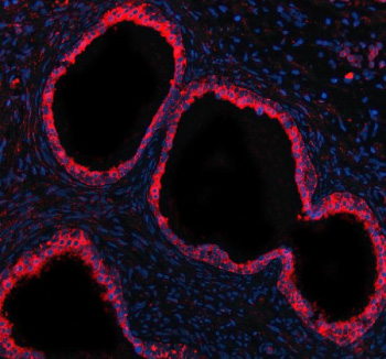 Immunofluorescent staining of GCNT2 using anti-GCNT2 antibody (red). GCNT2was detected in a paraffin-embedded section of human prostate cancer tissue. Heat mediated antigen retrieval was performed in EDTA buffer (pH 8.0, epitope retrieval solution). The tissue section was blocked with 10% goat serum. The tissue section was then incubated with 5 ug/ml rabbit anti-GCNT2 antibody overnight at 4oC. Cy3 Conjugated Goat Anti-Rabbit IgG was used as secondary antibody at 1:500 dilution and incubated for 30 minutes at 37oC. The section was counterstained with DAPI nuclear stain (blue). Visualize using a fluorescence microscope and filter sets appropriate for the label used.
