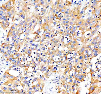 Immunohistochemical staining of CARD10 using anti-CARD10 antibody. CARD10 was detected in a paraffin-embedded section of human bladder cancer tissue. Heat mediated antigen retrieval was performed in EDTA buffer (pH 8.0, epitope retrieval solution). The tissue section was blocked with 10% goat serum. The tissue section was then incubated with 2 ug/ml rabbit anti-CARD10 antibody overnight at 4oC. Peroxidase Conjugated Goat Anti-rabbit IgG was used as secondary antibody and incubated for 30 minutes at 37oC. The tissue section was developed using an HRP secondary and DAB substrate.