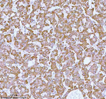 Immunohistochemical staining of using anti-ME3 antibody. ME3 was detected in a paraffin-embedded section of human liver cancer tissue. Heat mediated antigen retrieval was performed in EDTA buffer (pH 8.0, epitope retrieval solution). The tissue section was blocked with 10% goat serum. The tissue section was then incubated with 2 ug/ml rabbit anti-ME3 antibody overnight at 4oC. Peroxidase Conjugated Goat Anti-rabbit IgG was used as secondary antibody and incubated for 30 minutes at 37oC. The tissue section was developed using an HRP secondary and DAB substrate.