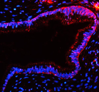 Immunofluorescent staining of TAS2R10 using anti-TAS2R10 antibody (red). TAS2R10 was detected in a paraffin-embedded section of human cervix cancer tissue. Heat mediated antigen retrieval was performed in EDTA buffer (pH 8.0, epitope retrieval solution). The tissue section was blocked with 10% goat serum. The tissue section was then incubated with 5 ug/ml rabbit anti-TAS2R10 antibody overnight at 4oC. DyLight 594 Conjugated Goat Anti-Rabbit IgG was used as secondary antibody at 1:500 dilution and incubated for 30 minutes at 37oC. The section was counterstained with DAPI nuclear stain (blue). Visualize using a fluorescence microscope and filter sets appropriate for the label used.