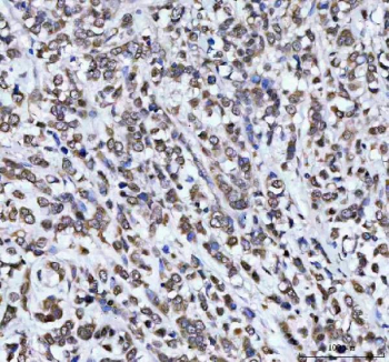 Immunohistochemical staining of AHCY using anti-AHCY antibody. AHCY was detected in a paraffin-embedded section of human breast cancer tissue. Heat mediated antigen retrieval was performed in EDTA buffer (pH 8.0, epitope retrieval solution). The tissue section was blocked with 10% goat serum. The tissue section was then incubated with 2 ug/ml rabbit anti-AHCY antibody overnight at 4oC. Peroxidase Conjugated Goat Anti-rabbit IgG was used as secondary antibody and incubated for 30 minutes at 37oC. The tissue section was developed using an HRP secondary and DAB substrate.