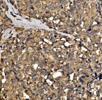 Immunohistochemical staining of FFPE human thyroid cancer tissue with SRP72 antibody, HRP-secondary and DAB substrate. HIER: boil tissue sections in pH8 EDTA for 20 min and allow to cool before testing.