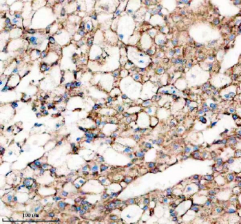 Immunohistochemical staining of FFPE human liver cancer tissue with Sonic Hedgehog antibody, HRP-secondary and DAB substrate. HIER: boil tissue sections in pH8 EDTA for 20 min and allow to cool before testing.