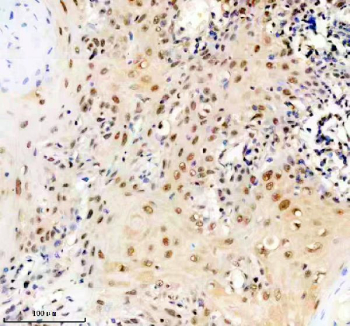 Immunohistochemical staining of FFPE human skin cancer tissue with ERCC2 antibody, HRP-secondary and DAB substrate. HIER: boil tissue sections in pH8 EDTA for 20 min and allow to cool before testing.