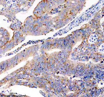 Immunohistochemical staining of FFPE human colon cancer tissue with USP14 antibody, HRP-secondary and DAB substrate. HIER: boil tissue sections in pH8 EDTA for 20 min and allow to cool before testing.
