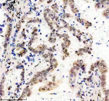 Immunohistochemical analysis of FTO using anti-FTO antibody. FTO is detected in a paraffin-embedded section of human lung cancer tissue following heat-mediated antigen retrieval in EDTA buffer (pH 8.0). Positive cell-associated staining is observed in tumor cells, consistent with reported FTO expression patterns.