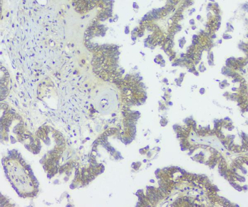 Immunohistochemical staining of FFPE human ovarian cancer tissue using GNAQ antibody, HRP-secondary and DAB substrate. HIER: boil tissue sections in pH8 EDTA for 20 min and allow to cool before testing. Guanine nucleotide binding protein Gq subunit alpha shows cytoplasmic staining in tumor epithelial cells, with comparatively lower signal in surrounding stromal regions.