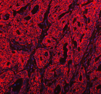 Immunofluorescent staining of FFPE human colorectal cancer tissue with PKP3 antibody (red) and DAPI nuclear stain (blue). HIER: steam section in pH8 EDTA buffer for 20 min.