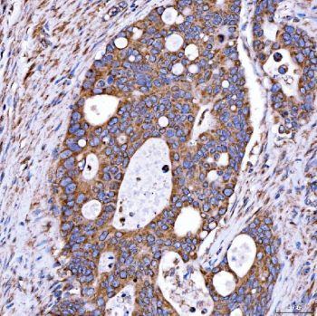 Immunohistochemical staining of FFPE human duodenal papilla adenocarcinoma tissue with RAB7A antibody, HRP-secondary and DAB substrate. HIER: boil tissue sections in pH8 EDTA for 20 min and allow to cool before testing.