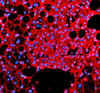 Immunofluorescence analysis of Indian hedgehog protein using IHH antibody. Indian hedgehog protein expression was examined in a paraffin-embedded section of human liver cancer tissue. Heat-mediated antigen retrieval was performed using EDTA buffer (pH 8.0). Tissue sections were blocked with normal goat serum and incubated with IHH antibody overnight at 4Â°C. Detection was performed using a Cy3-conjugated secondary antibody, and nuclei were counterstained with DAPI. Fluorescent images were acquired using appropriate filter sets.