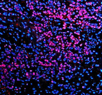 Immunofluorescence analysis of TBX5 using anti-TBX5 antibody. TBX5 expression was examined in a paraffin-embedded section of human lung cancer tissue. Heat-mediated antigen retrieval was performed using EDTA buffer (pH 8.0), followed by blocking with goat serum. The tissue section was incubated with a rabbit anti-TBX5 antibody overnight at 4Â°C, then stained with a Cy3-conjugated goat anti-rabbit secondary antibody. Nuclei were counterstained with DAPI. Fluorescent signals were visualized by fluorescence microscopy, revealing prominent nuclear localization of TBX5 consistent with its role as a transcription factor.