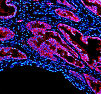 Immunofluorescence analysis of PDLIM5 using anti-PDLIM5 antibody. PDLIM5 expression was evaluated in a paraffin-embedded section of human prostate cancer tissue. After heat-mediated antigen retrieval in EDTA buffer (pH 8.0) and blocking with 10% goat serum, the tissue was incubated with rabbit anti-PDLIM5 antibody overnight at 4Â°C. Fluorescent detection was performed using a Cy3-conjugated secondary antibody (red), with nuclei counterstained using DAPI (blue), demonstrating prominent cytoplasmic localization of PDLIM5.