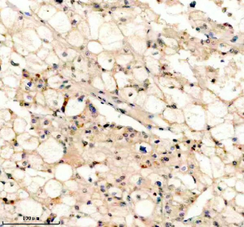 Immunohistochemistry analysis of Peroxisomal biogenesis factor 5 using PEX5 antibody. PEX5 expression was examined in a paraffin-embedded section of human liver cancer tissue. Heat-mediated antigen retrieval was performed using EDTA buffer (pH 8.0). Tissue sections were blocked with normal goat serum and incubated with PEX5 antibody overnight at 4C. Immunoreactivity is observed predominantly in tumor epithelial cells, with cytoplasmic staining consistent with peroxisomal localization. Detection was visualized using an HRP-based detection system with DAB chromogen, followed by hematoxylin counterstaining.