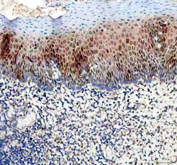 IHC analysis of DUT Antibody / Deoxyuridine triphosphatase. DUT expression was examined in a paraffin-embedded section of human tonsil tissue. Following heat-mediated antigen retrieval in EDTA buffer (pH 8.0), tissue sections were blocked with goat serum and incubated with a rabbit anti-DUT antibody. Immunoreactivity was visualized using an HRP-based detection system with DAB chromogen. Prominent nuclear staining is observed in lymphoid cells within germinal center regions, consistent with the role of DUT in DNA replication and nucleotide metabolism in proliferating cells.