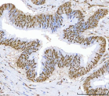 IHC analysis of c-Myc in human colorectal adenocarcinoma tissue. Paraffin-embedded human colorectal adenocarcinoma tissue was stained with c-Myc / MYC antibody following pH8 EDTA heat-mediated antigen retrieval. Strong nuclear staining is observed in tumor epithelial cells, consistent with elevated c-Myc expression in malignant tissue. Scale bar: 100 um.