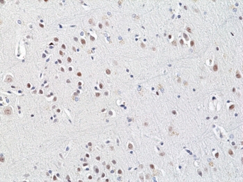 IHC staining of FFPE human brain cancer tissue with recombinant HDCAC3 antibody at 1:200.