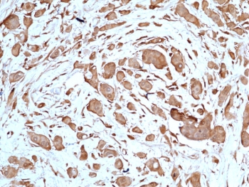 IHC staining of FFPE human breast cancer tissue with recombinant STAT3 antibody at 1:50.