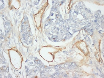 IHC-P: Collagen IV antibody testing of human breast cancer tissue. HIER: steamed with pH6 citrate buffer, HRP-staining. 