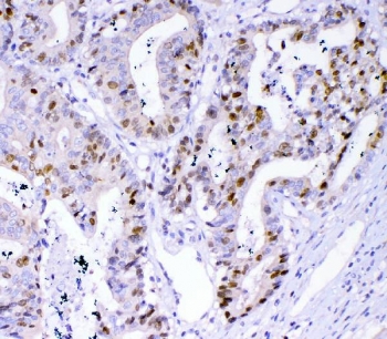 IHC staining of FFPE human colon cancer tissue with Survivin antibody. HIER: boil tissue sections in pH8 EDTA for 20 min and allow to cool before testing.