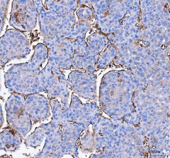 IHC staining of FFPE human liver cancer tissue with AQP1 antibody. HIER: boil tissue sections in pH8 EDTA for 20 min and allow to cool before testing.