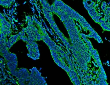 Immunofluorescent staining of FFPE human colon cancer tissue with N-Cadherin antibody (green) and DAPI nuclear stain (blue). HIER: steam section in pH8 EDTA for 20 min.