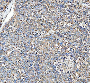 IHC staining of FFPE human liver cancer tissue with HSD11B1 antibody. HIER: boil tissue sections in pH8 EDTA for 20 min and allow to cool before testing.