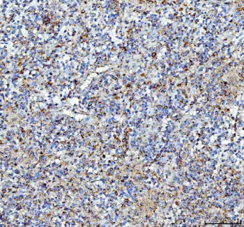 IHC staining of FFPE human glioma tissue with Pleiotrophin antibody, HRP-labeled secondary and DAB substrate. HIER: boil tissue sections in pH8 EDTA for 20 min and allow to cool before testing.