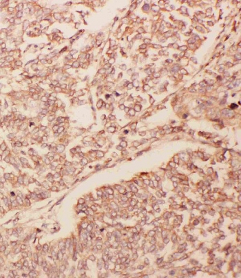 IHC staining of FFPE human lung cancer with GDNF antibody. HIER: boil tissue sections in pH6, 10mM citrate buffer, for 20 min and allow to cool before testing.