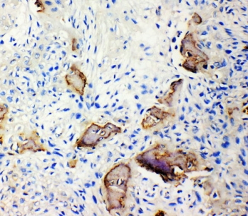 IHC-P: IBSP antibody testing of human osteosarcoma