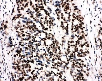 IHC-P: Ku80 antibody testing of human breast cancer tissue. HIER: boil tissue sections in pH6, 10mM citrate buffer, for 20 min and allow to cool before testing.